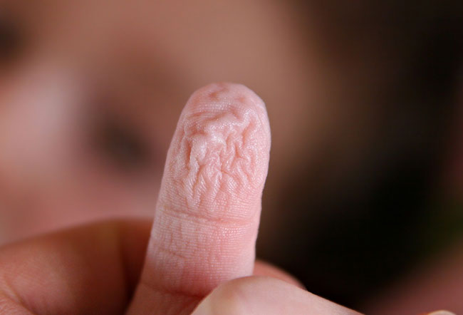 Wrinkly Hand แสนสงสัยทำไมมือเปื่อย