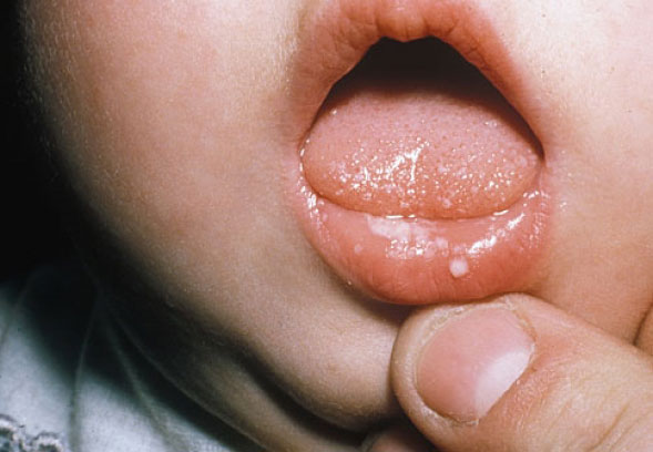 ร้อนใน ปวดใจจริงๆ That’s Hurt