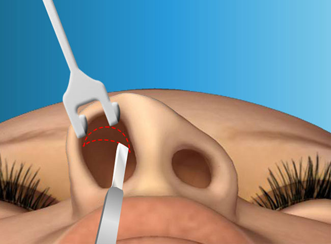 การศัลยกรรมจมูกแบบ Open Rhinoplasty คืออะไร