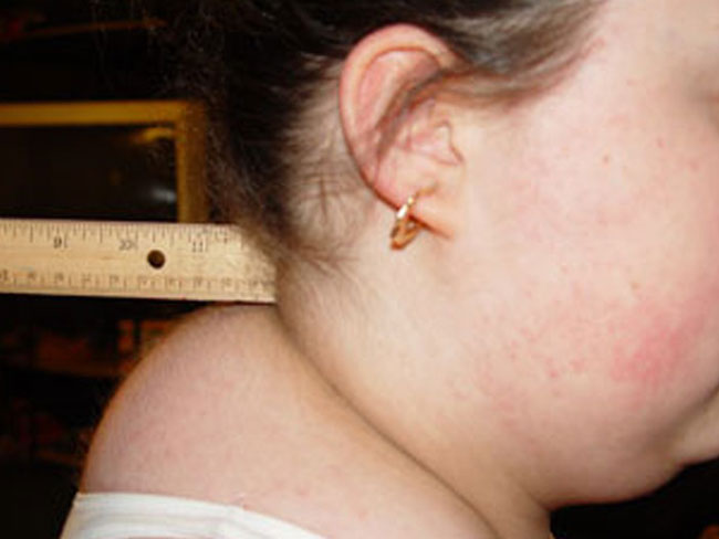 Buffalo Hump รีดสันหนอก เพื่อคอเรียว หนอกคอ