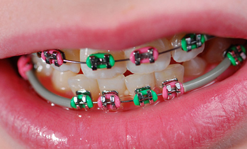 อย่าให้ลูกจัดฟัน ตามแฟชั่น