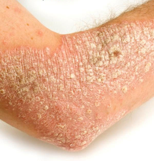 Scleroderma โรคหนังแข็ง