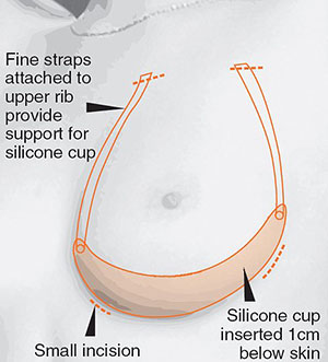 การผ่าตัดเสริมหน้าอกด้วยบราซิลิโคนถาวร Internal Bra