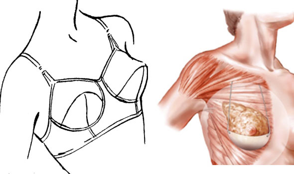 การผ่าตัดเสริมหน้าอกด้วยบราซิลิโคนถาวร Internal Bra