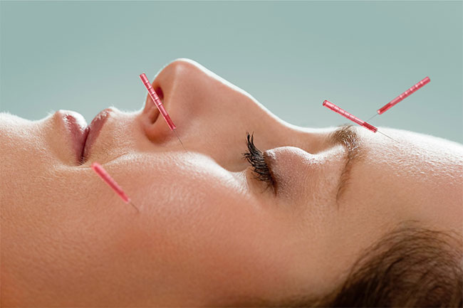 ฝังเข็มหน้าเด้ง ปรับสมดุลเพื่อผิวสวย Acupuncture Therapy
