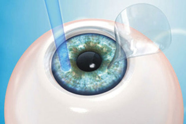 ทำเลสิก ไม่เจ็บอย่างที่คิด Lasik