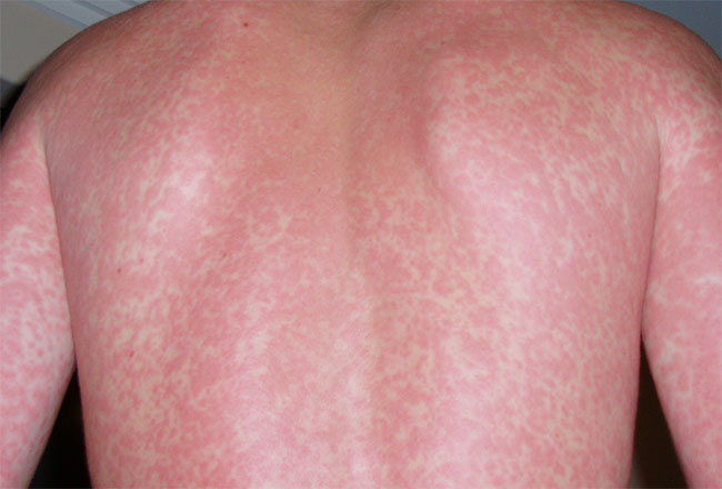 แพ้ยาผื่นคันขึ้นอันตรายถึงชีวิต