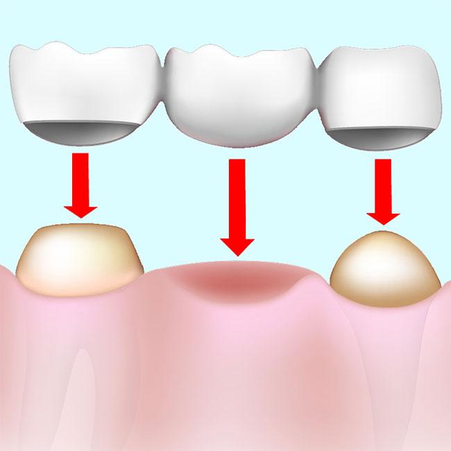 สะพานฟัน