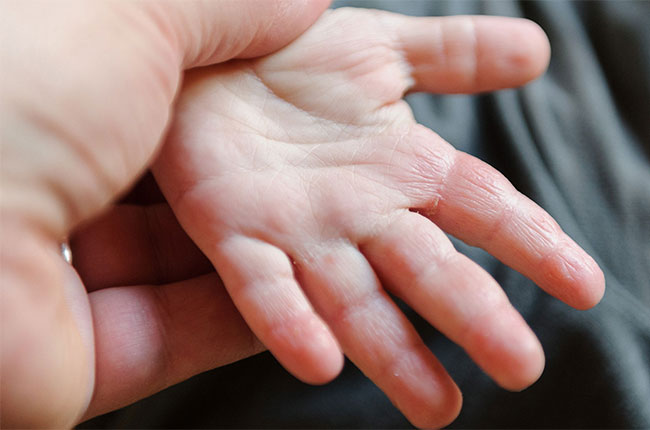 โรคผิวหนังอักเสบในเด็กที่มักพบบ่อย ตอนที่ 1