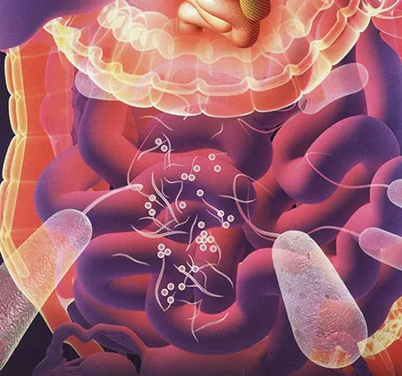 ลำไส้อักเสบ โรคลำไส้อักเสบ