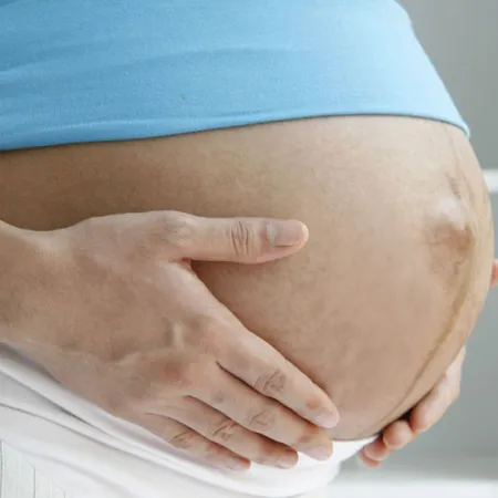 การคลอดด้วยการผ่าคลอด