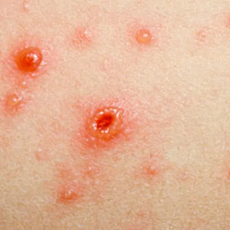 ถ้าเป็นอีสุกอีใส เวลาอาบน้ำควรใช้สบู่ธรรมดาหรือสบู่ยา