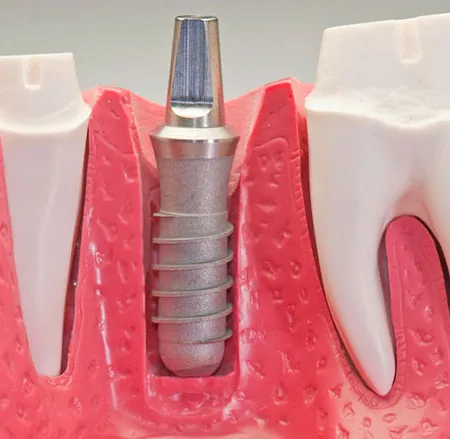 รากฟันเทียม