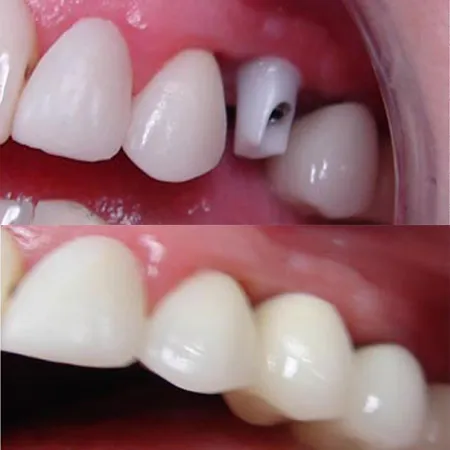 ข้อจำกัด รากฟันเทียม (ตอนจบ)