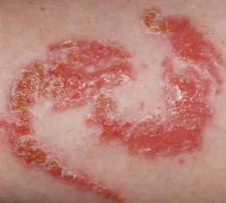 ระวังผิวไหม้จากรอยเพ้นท์ (เพ้นท์เฮนน่า)