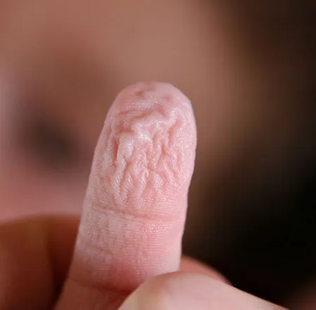 Wrinkly Hand แสนสงสัยทำไมมือเปื่อย