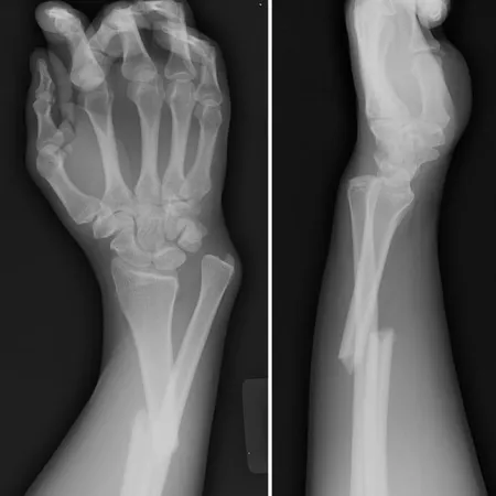 Broken Bone! เมื่อเจ้าตัวดีกระดูกหัก