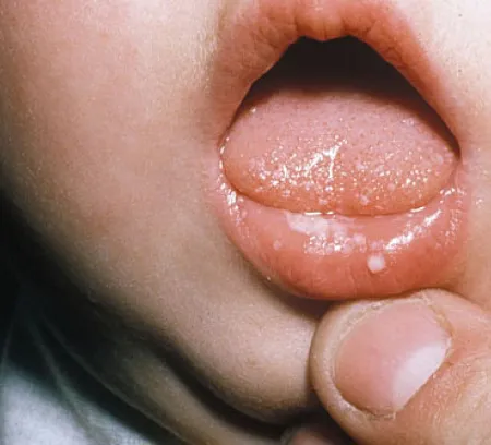 ร้อนใน ปวดใจจริงๆ That’s Hurt