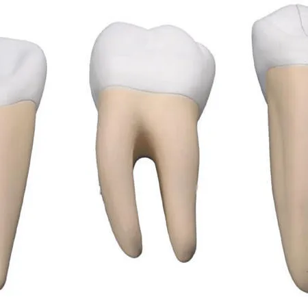ฟัน (หน้า) ห่าง แก้ปัญหาช่องฟันหน้าห่าง