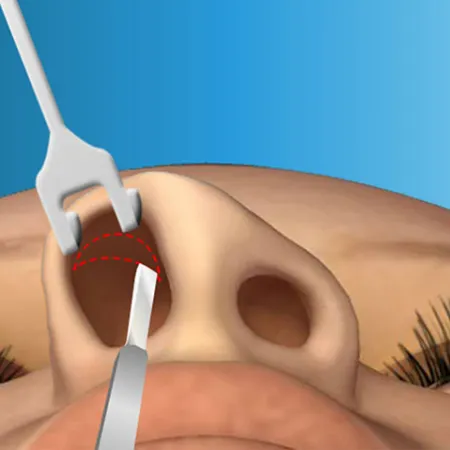 การศัลยกรรมจมูกแบบ Open Rhinoplasty คืออะไร