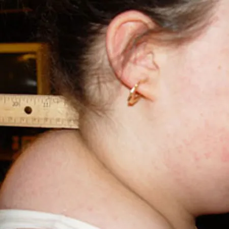 Buffalo Hump รีดสันหนอก เพื่อคอเรียว หนอกคอ