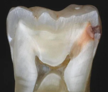 ฟันผุต้นเหตุโรคฝีในสมอง