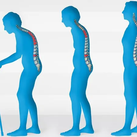 ภาวะกระดูกพรุน (Osteoporosis)