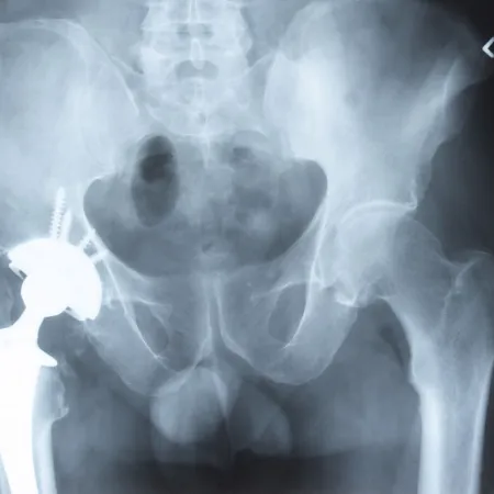 ข้อสะโพกเทียมไม่แท้แต่แก้ได้