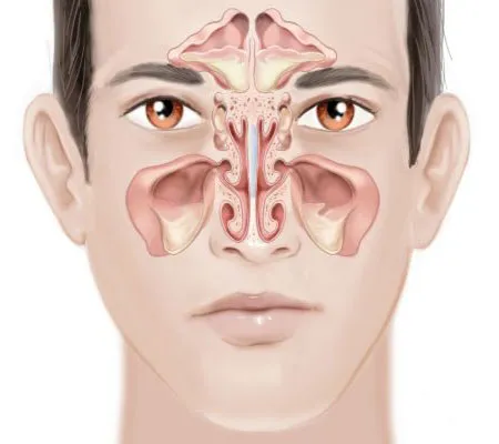 ไซนัสอักเสบ (Sinusitis)