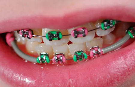 อย่าให้ลูกจัดฟัน ตามแฟชั่น