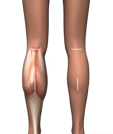ลดน่องปูด น่องโต โชว์ขาเรียว Calf Muscle Reduction