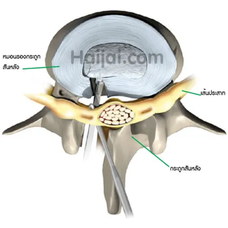 หมอนรองกระดูกสันหลังเคลื่อน