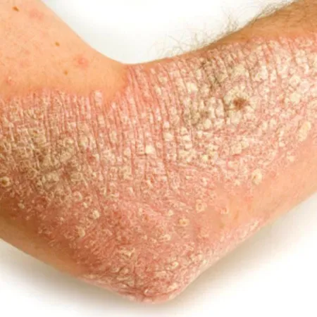 Scleroderma โรคหนังแข็ง