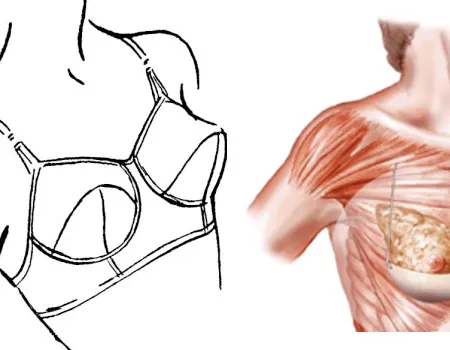 การผ่าตัดเสริมหน้าอกด้วยบราซิลิโคนถาวร Internal Bra