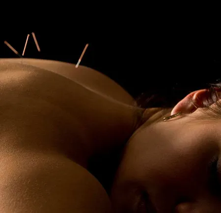 การฝังเข็ม รักษาฝ้า