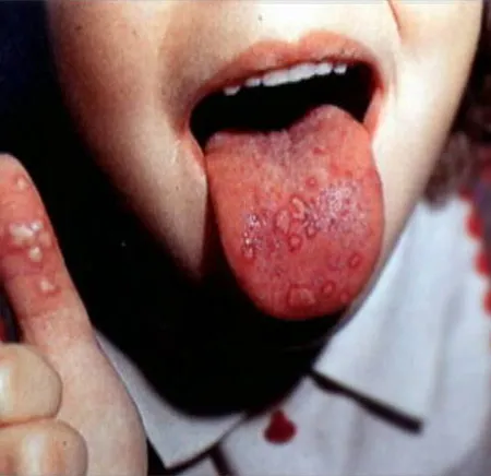 โรคมือเท้าปากเกิดจากอะไร