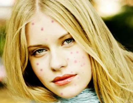 ป่วยอีสุกอีใส ห้ามกินแอสไพรินเด็ดขาด