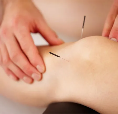 บำบัดอาการอาหารไม่ย่อย ด้วยศาสตร์ฝังเข็ม