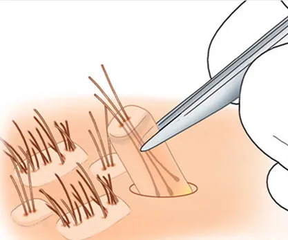 การแซมผมปลอม แก้ไขจุดบกพร่อง เพื่อบุคลิกภาพที่ดี