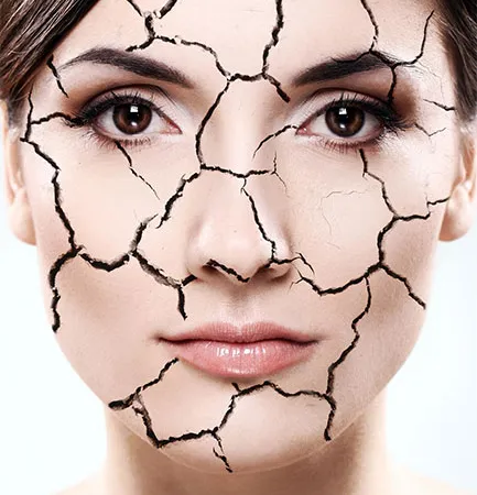 ผิวแห้ง Dry Skin