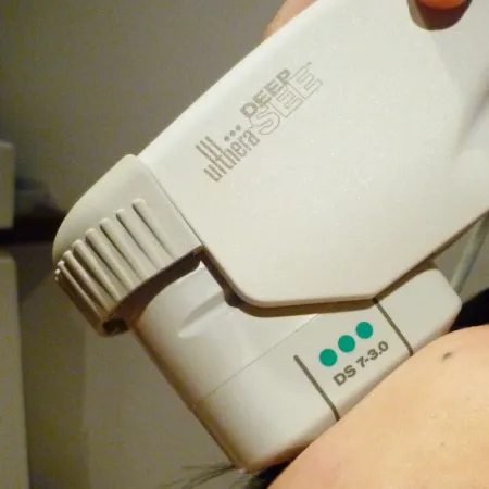 Ulthera และ Thermage ยกกระชับผิวหน้าแตกต่างกันอย่างไร