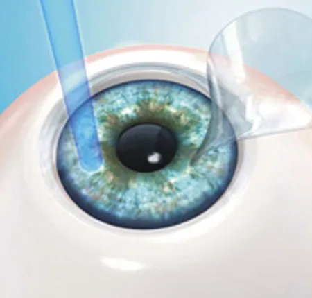 ทำเลสิก ไม่เจ็บอย่างที่คิด Lasik