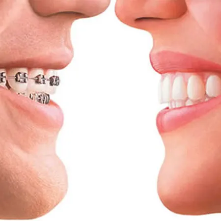 เครื่องฉีดน้ำในปากสำหรับคนจัดฟัน