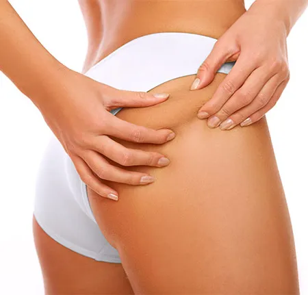 เซลลูไลท์บุกแล้ว จะปล่อยให้มันแพร่พันธุ์ไม่ได้นะ