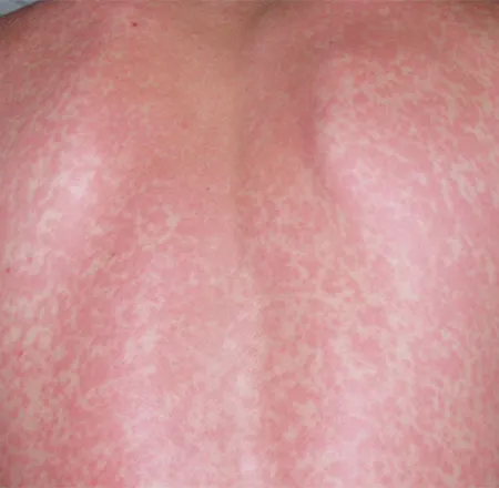 แพ้ยาผื่นคันขึ้นอันตรายถึงชีวิต