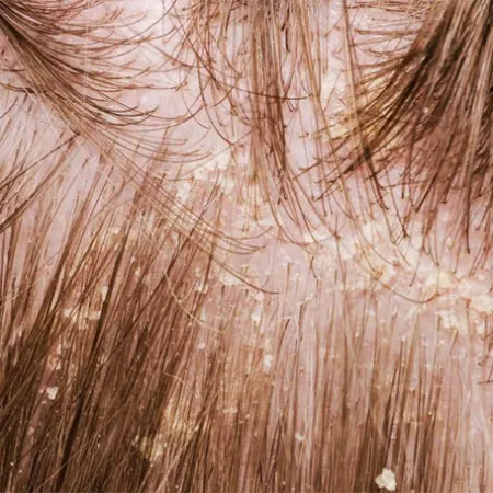 2 วิธีธรรมชาติสยบโรคสะเก็ดเงิน