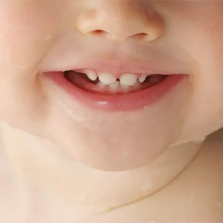 สุขภาพฟันน้ำนมในช่องปากเด็กเล็ก