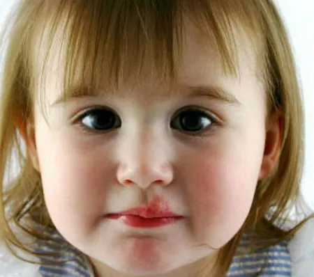 ลูกเป็นแผลในปาก