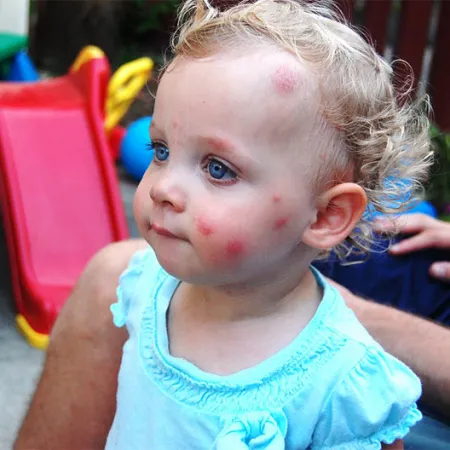 การป้องกันแมลงร้ายกัดเจ้าตัวเล็ก