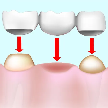 สะพานฟัน